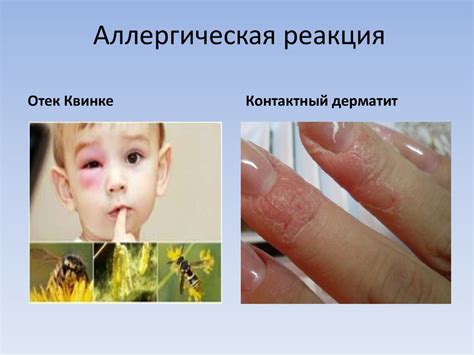 Аллергическая реакция на клей или материалы