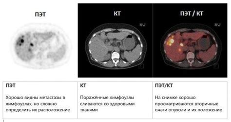 Влияние углеводов на результаты ПЭТ-КТ