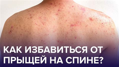 Влияние ухода за кожей на прыщи