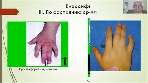 Врожденные аномалии развития конечности
