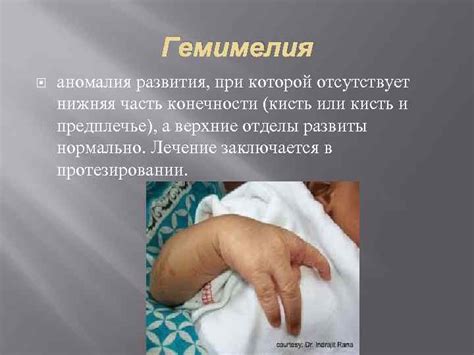 Врожденные аномалии руки прокурора