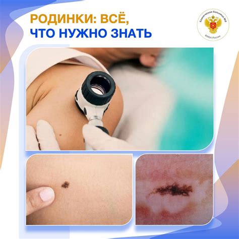 Исторические факты и предрассудки о родинках у мужчин
