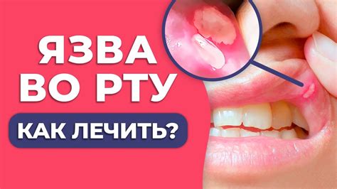 Как избежать появления привкуса крови во рту при употреблении гематогена