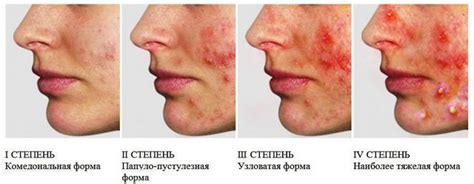 Механизм возникновения прыщей на лице