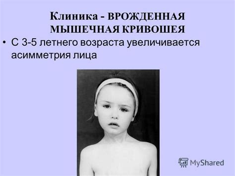 Мышечная асимметрия