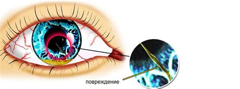 Ожоги роговицы и другие механические повреждения
