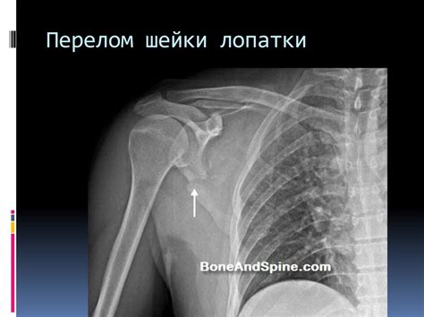 Повреждение вилочной шейки