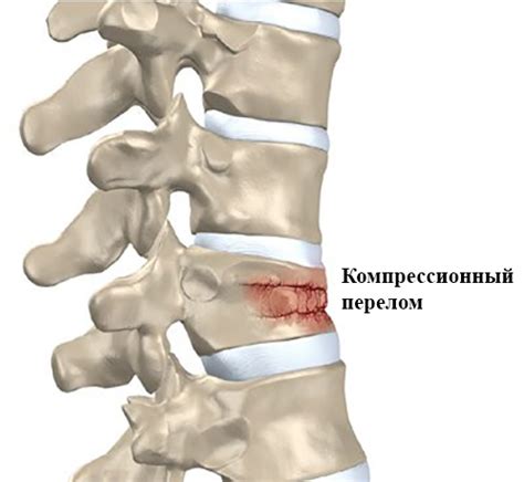 Повреждение позвоночника