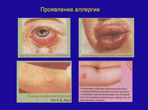 Повышенный риск аллергической реакции:
