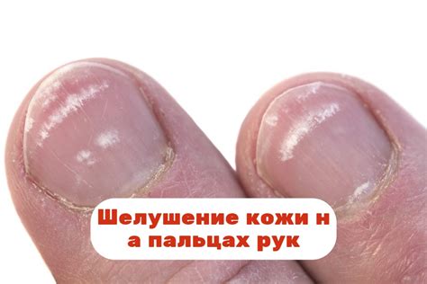 Причины появления обесцвеченной кожи на пальцах