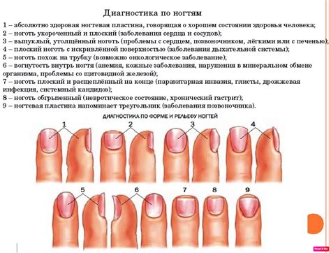 Причины сворачивания ногтей