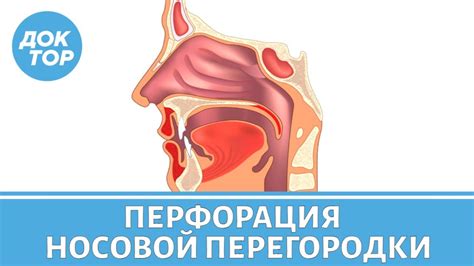 Проблема в носовой перегородке
