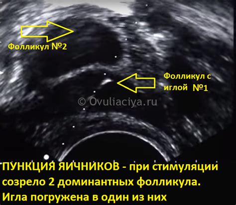Прогнозирование роста фолликулов при стимуляции гоналом