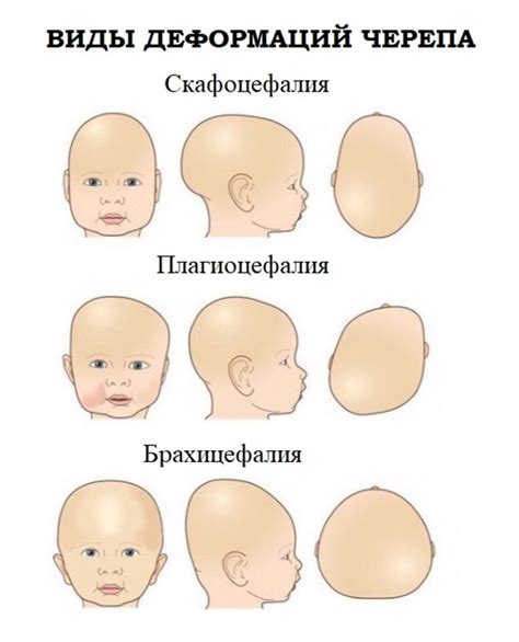 Процесс коррекции формы головы у узбеков