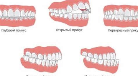 Различные формы зубных дуг