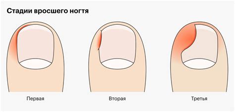 Что такое сворачивание ногтей